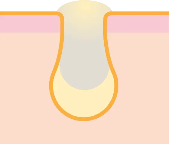 詰まり毛穴イメージ1