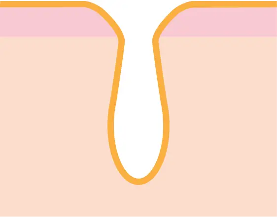 すり鉢毛穴イメージ1