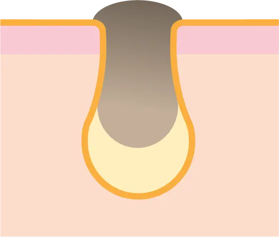 黒ずみ毛穴イメージ1